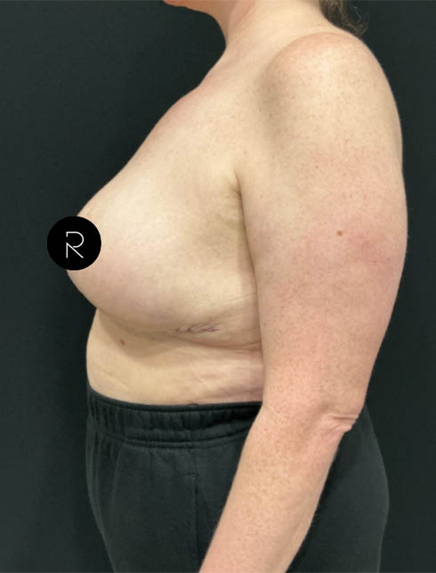 Breast Lift/Reduction