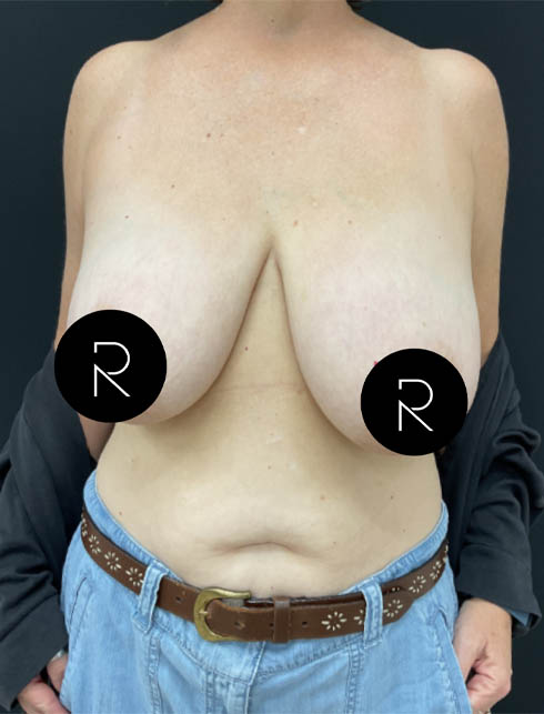 Breast Lift/Reduction