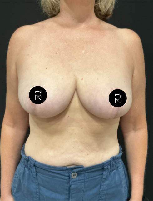 Breast Lift/Reduction