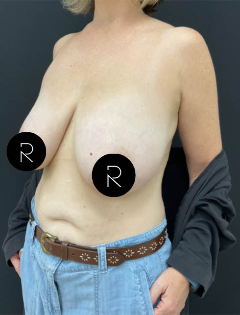 Breast Lift/Reduction