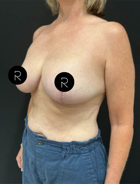 Breast Lift/Reduction