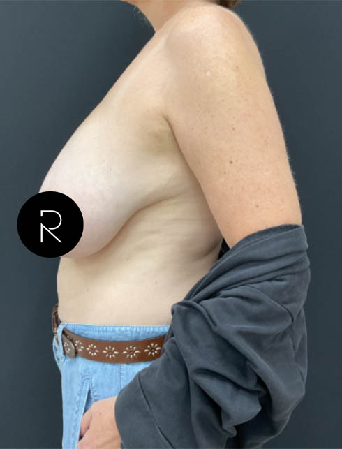 Breast Lift/Reduction
