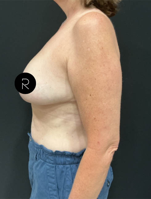 Breast Lift/Reduction
