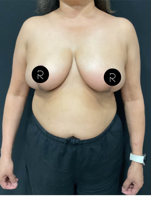 Breast Lift/Reduction