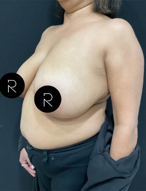 Breast Lift/Reduction