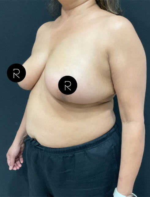 Breast Lift/Reduction