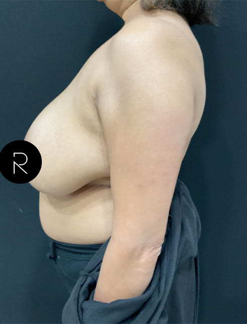 Breast Lift/Reduction