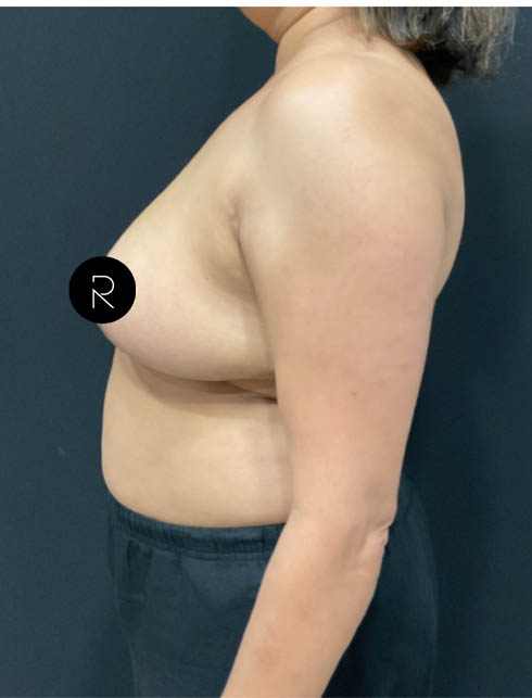 Breast Lift/Reduction