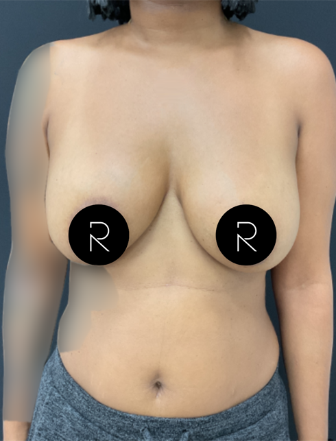 Breast Implant Removal