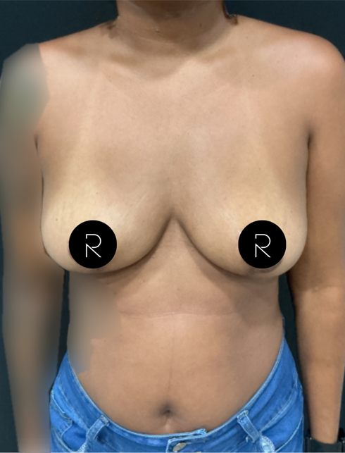 Breast Implant Removal
