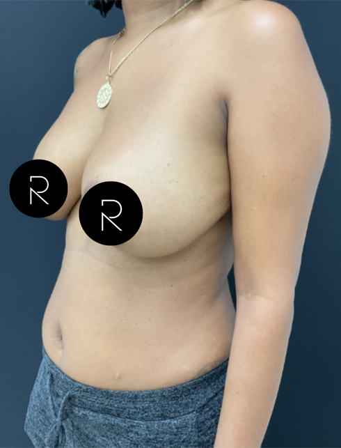 Breast Implant Removal