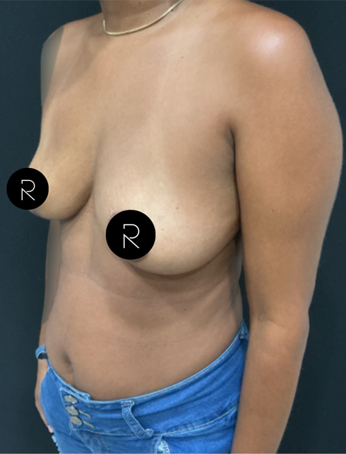 Breast Implant Removal