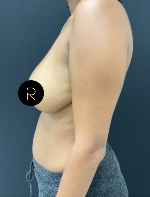 Breast Implant Removal