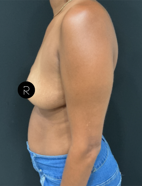Breast Implant Removal