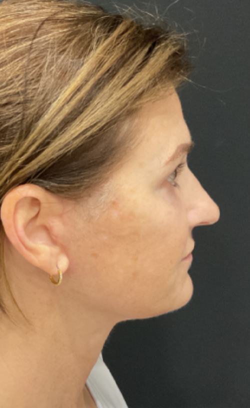 Facelift/Neck Lift