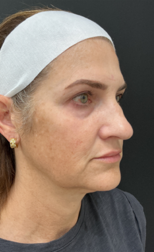 Facelift/Neck Lift