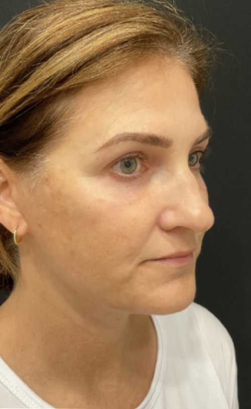 Facelift/Neck Lift