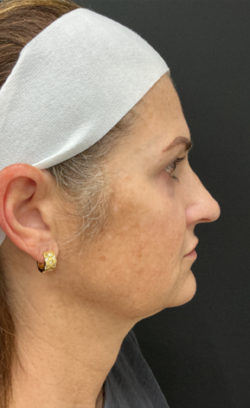 Facelift/Neck Lift