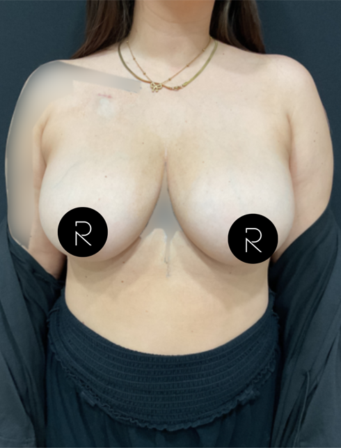 Breast Lift/Reduction