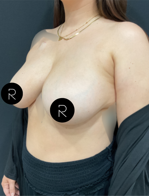 Breast Lift/Reduction
