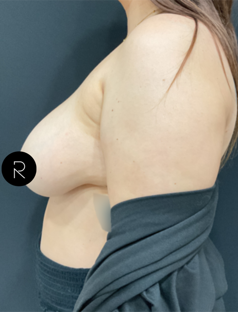 Breast Lift/Reduction