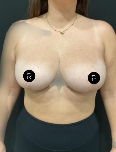 Breast Lift/Reduction