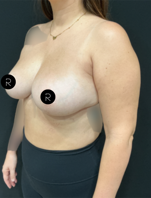 Breast Lift/Reduction