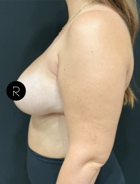 Breast Lift/Reduction