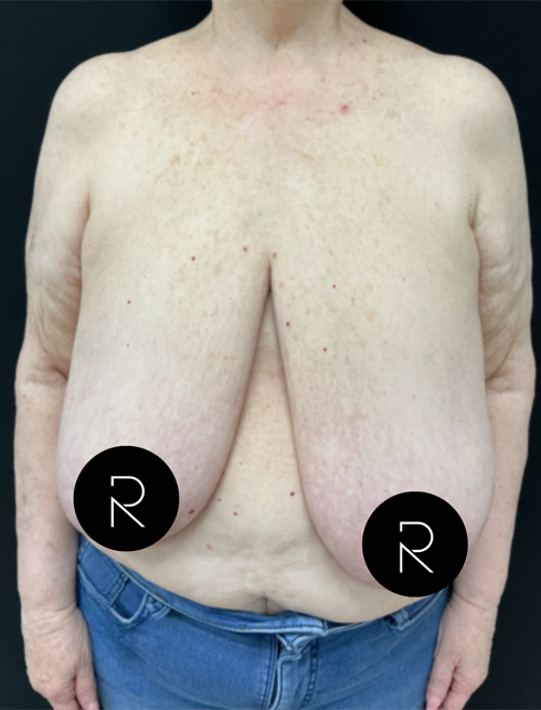 Breast Lift/Reduction