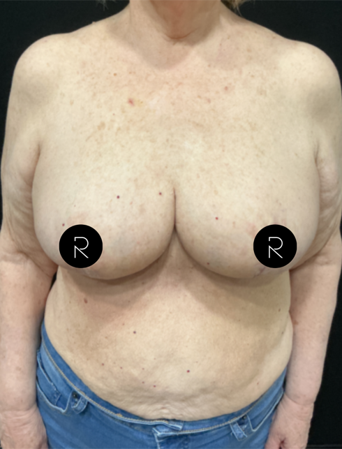 Breast Lift/Reduction