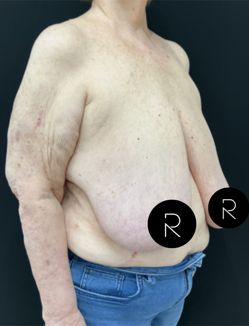 Breast Lift/Reduction