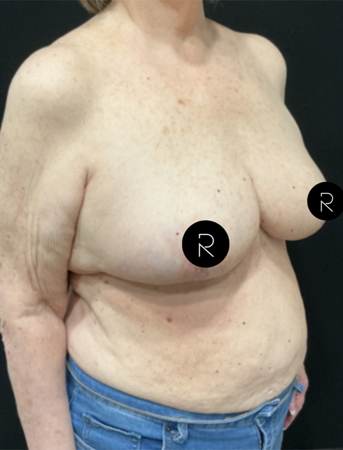 Breast Lift/Reduction