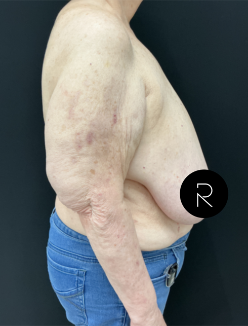 Breast Lift/Reduction
