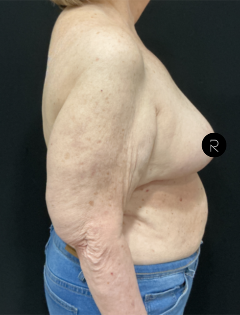 Breast Lift/Reduction