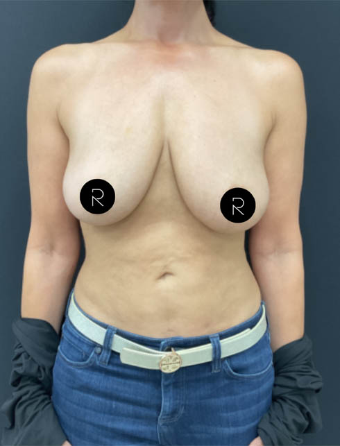 Breast Augmentation