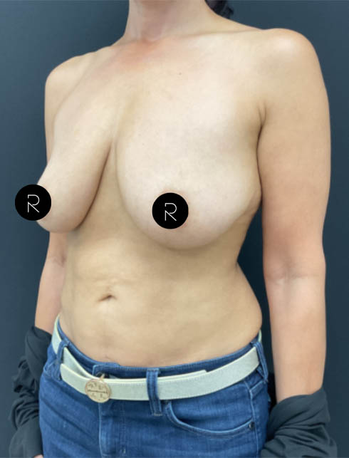 Breast Augmentation