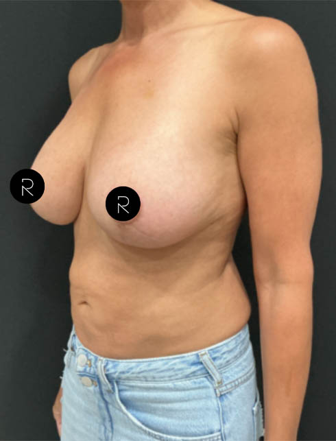 Breast Augmentation