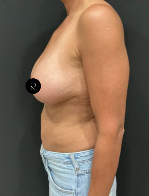 Breast Augmentation