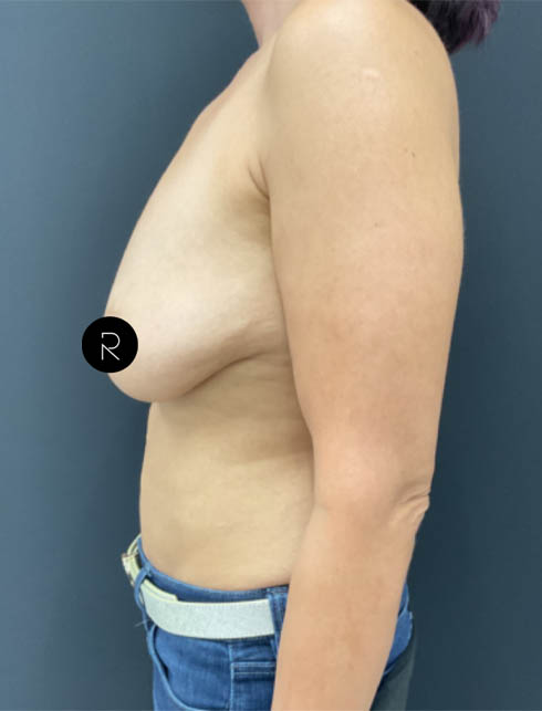 Breast Augmentation