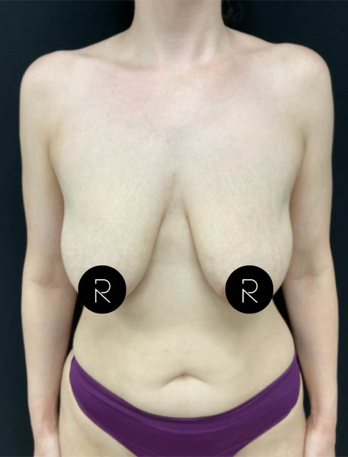 Breast Lift/Reduction