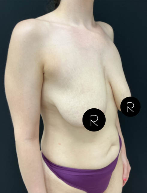Breast Lift/Reduction