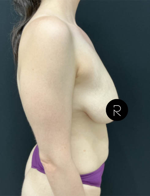 Breast Lift/Reduction