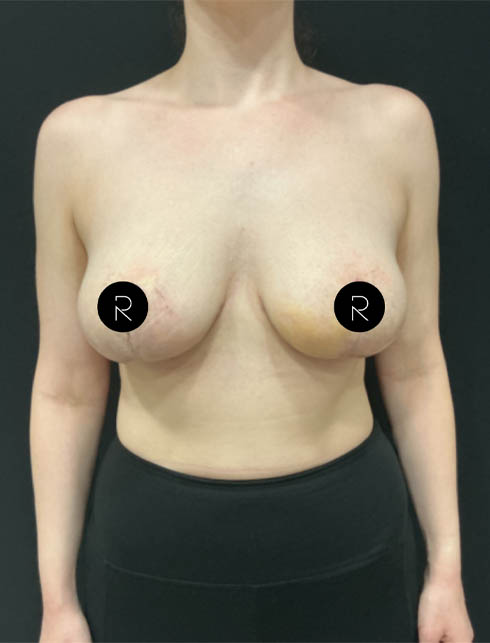 Breast Lift/Reduction