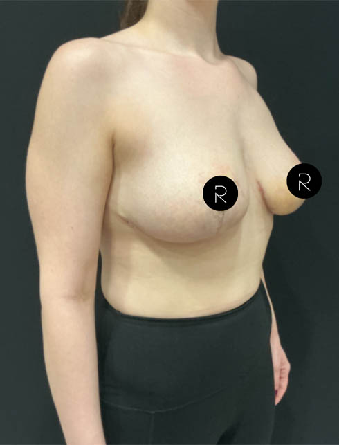 Breast Lift/Reduction