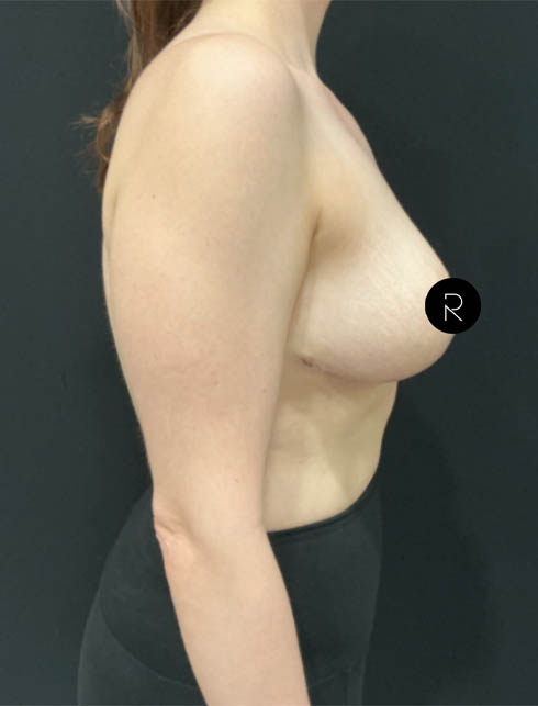 Breast Lift/Reduction