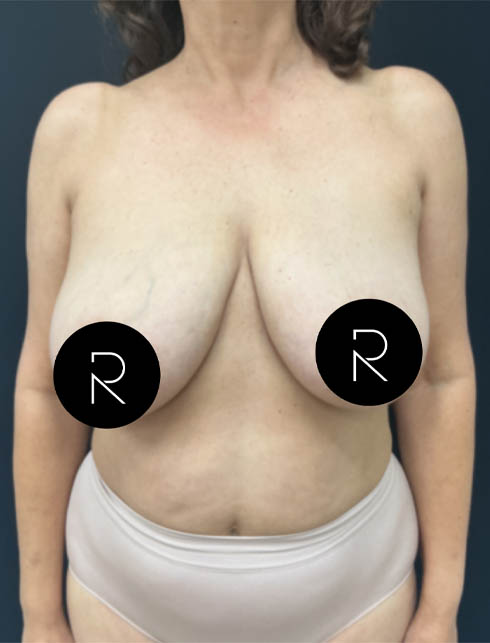 Breast Lift/Reduction