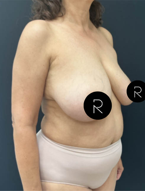 Breast Lift/Reduction