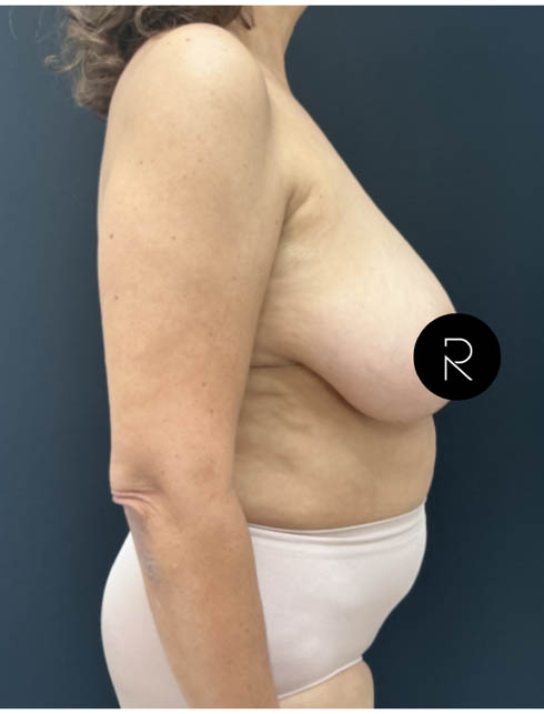 Breast Lift/Reduction