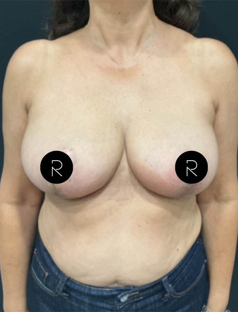 Breast Lift/Reduction