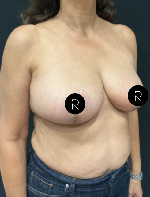 Breast Lift/Reduction